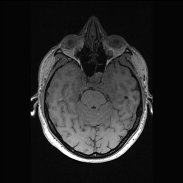 File:Central base of skull meningioma (Radiopaedia 53531-59549 Axial T1 13).jpg