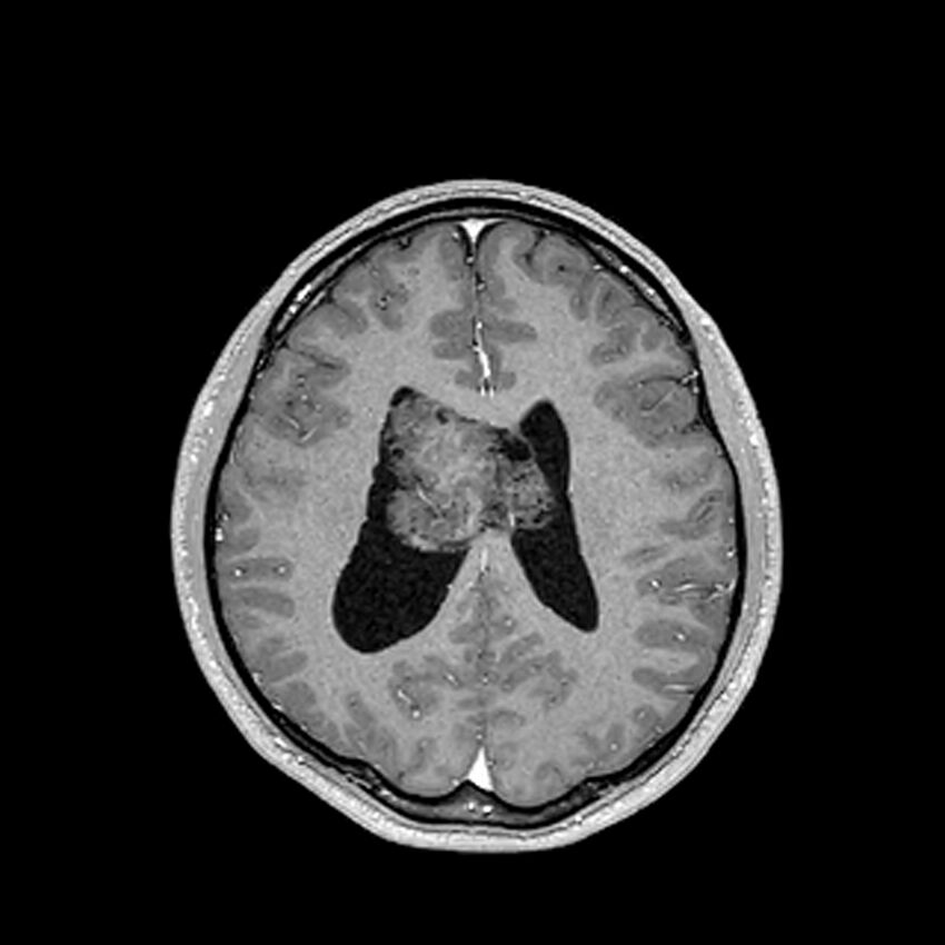 Central neurocytoma (Radiopaedia 79320-92380 Axial T1 C+ 157).jpg