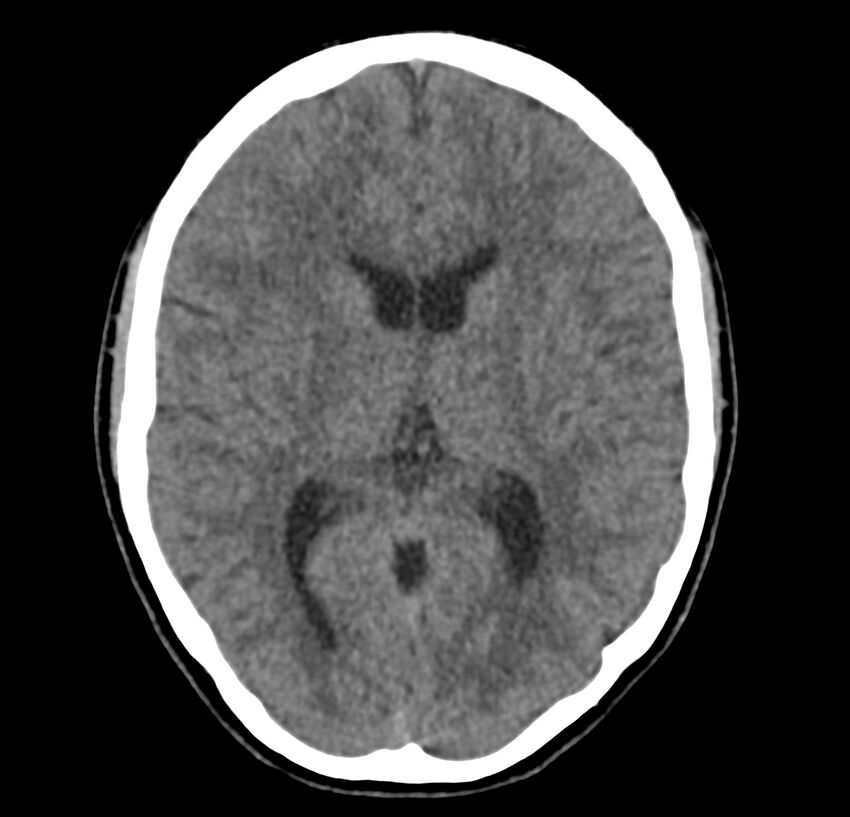 Cerebellar agenesis (Radiopaedia 30203-30817 Axial non-contrast 25).jpg