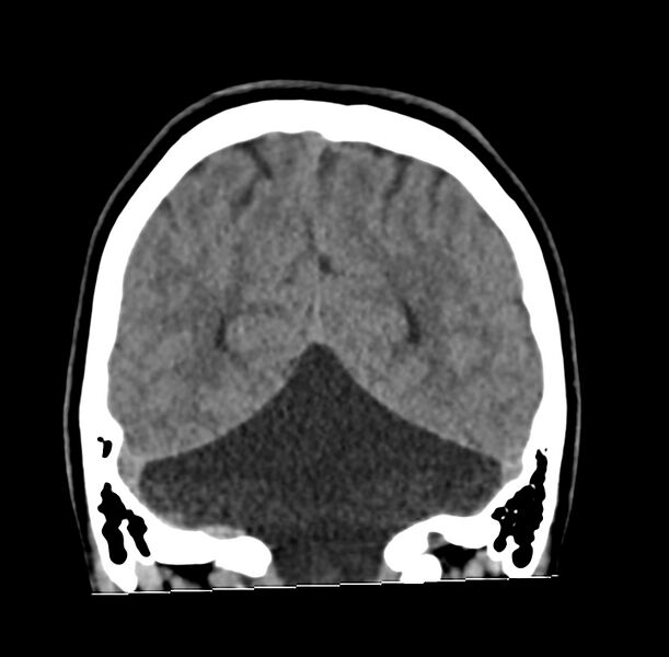 File:Cerebellar agenesis (Radiopaedia 30203-30817 Coronal non-contrast 36).jpg