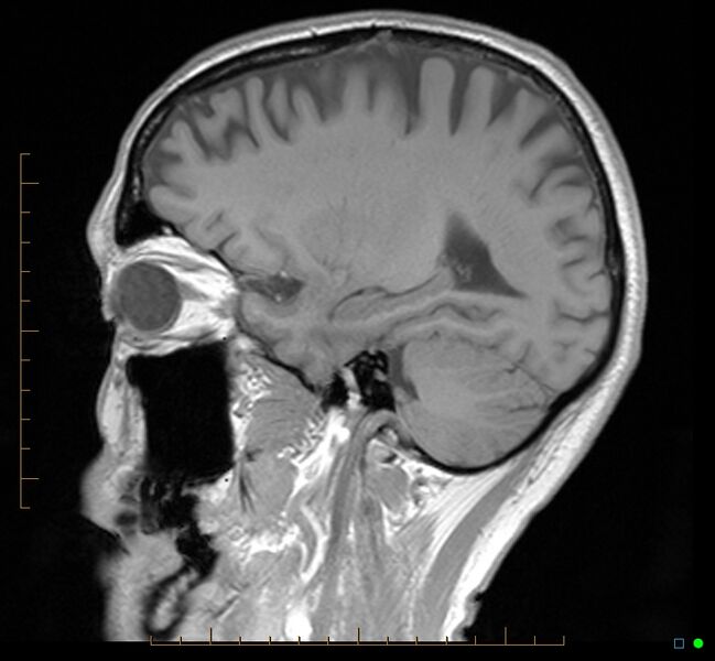 File:Cerebellar gangliocytoma (Radiopaedia 65377-74422 Sagittal T1 30).jpg