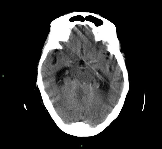 File:Cerebellar hemorrhage (Radiopaedia 58792-66026 Axial non-contrast 31).jpg