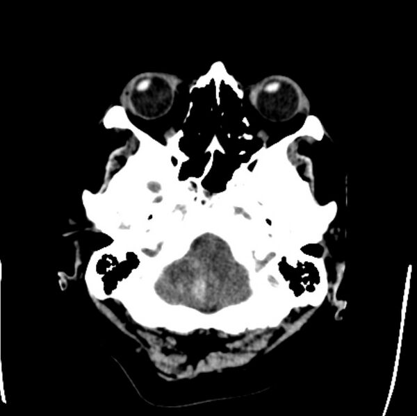 File:Cerebellar hemorrhage causing obstructive hydrocephalus (Radiopaedia 33989-35207 Axial non-contrast 7).jpg