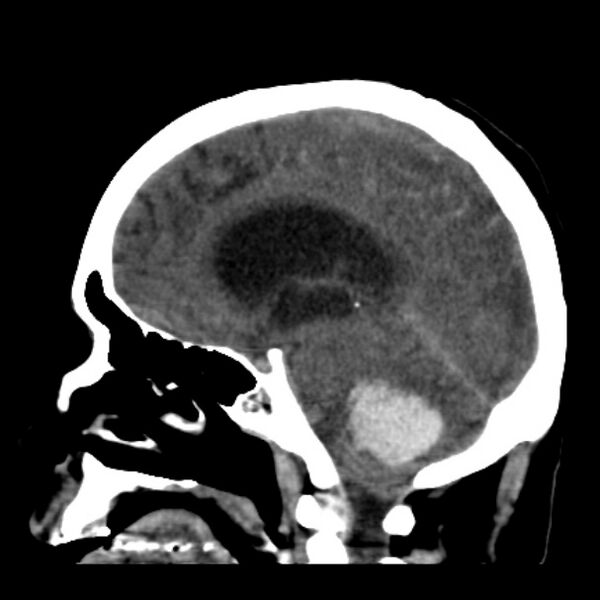 File:Cerebellar hemorrhage causing obstructive hydrocephalus (Radiopaedia 33989-35207 B 23).jpg