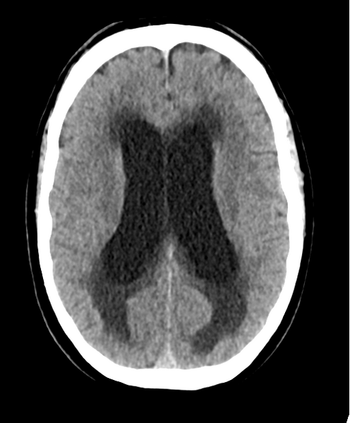 File:Cerebellar metastasis from lung adenocarcinoma (Radiopaedia 86690-102828 Axial non-contrast 18).png