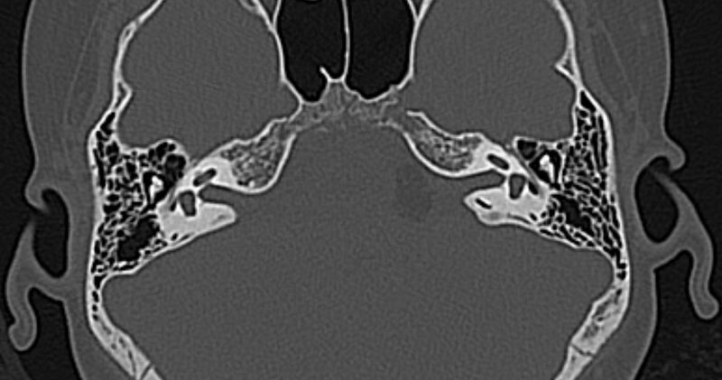 File:Cerebellopontine angle lipoma (Radiopaedia 57303-64242 Axial bone window 30).jpg