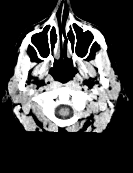 File:Cerebral abscess (Radiopaedia 60342-68008 Axial non-contrast 2).png