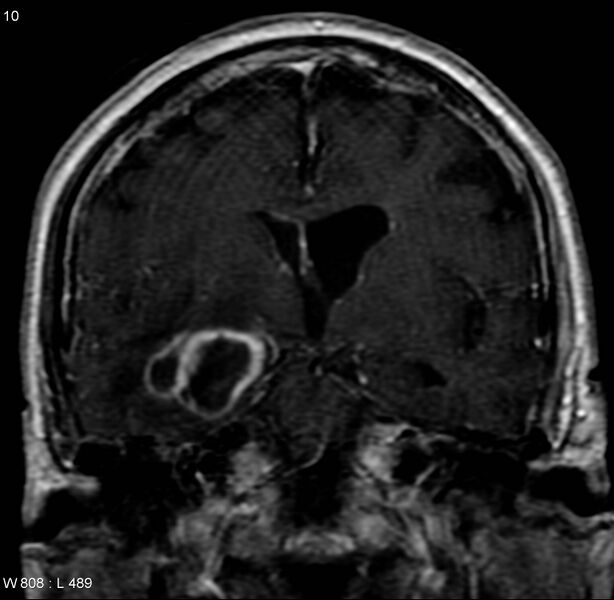 File:Cerebral abscess and ventriculitis (Radiopaedia 5024-6885 Coronal T1 C+ 2).jpg