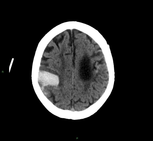 File:Cerebral amyloid angiopathy-associated lobar intracerebral hemorrhage (Radiopaedia 58376-65513 Axial non-contrast 15).jpg