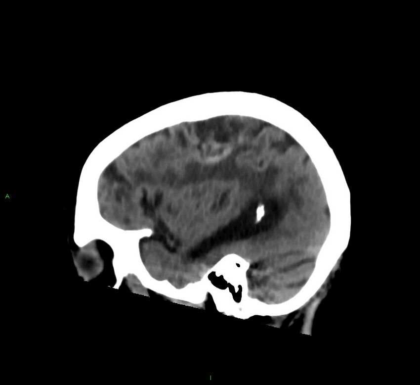 Cerebral amyloid angiopathy-associated lobar intracerebral hemorrhage (Radiopaedia 58376-65513 C 51).jpg