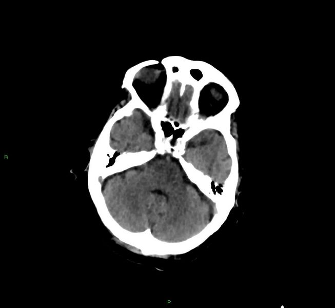 File:Cerebral amyloid angiopathy-associated lobar intracerebral hemorrhage (Radiopaedia 58377-65514 Axial non-contrast 36).jpg