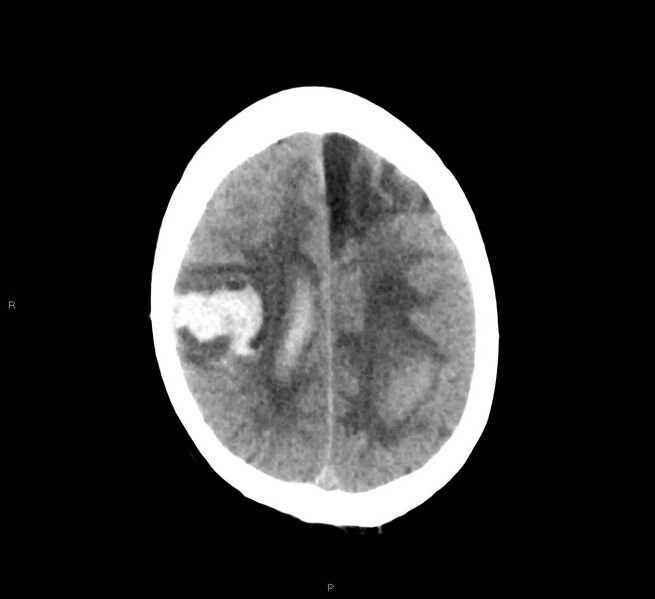 File:Cerebral amyloid angiopathy-associated lobar intracerebral hemorrhage (Radiopaedia 58529-65687 Axial non-contrast 15).jpg