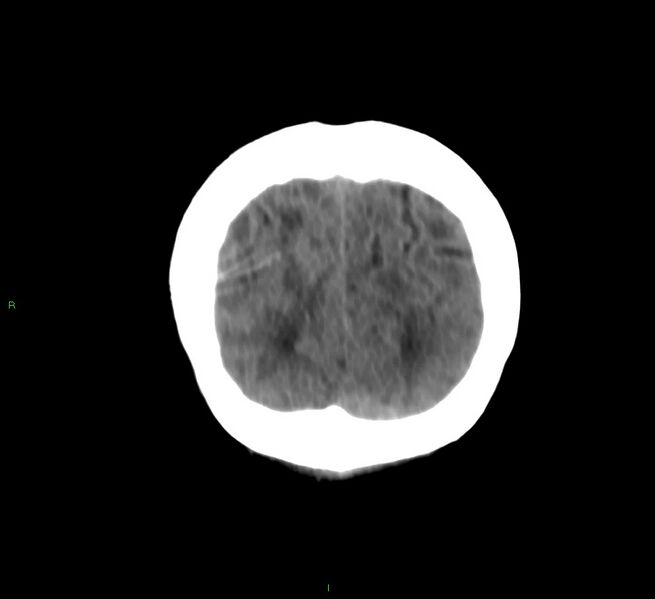 File:Cerebral amyloid angiopathy-associated lobar intracerebral hemorrhage (Radiopaedia 58566-65730 Coronal non-contrast 13).jpg
