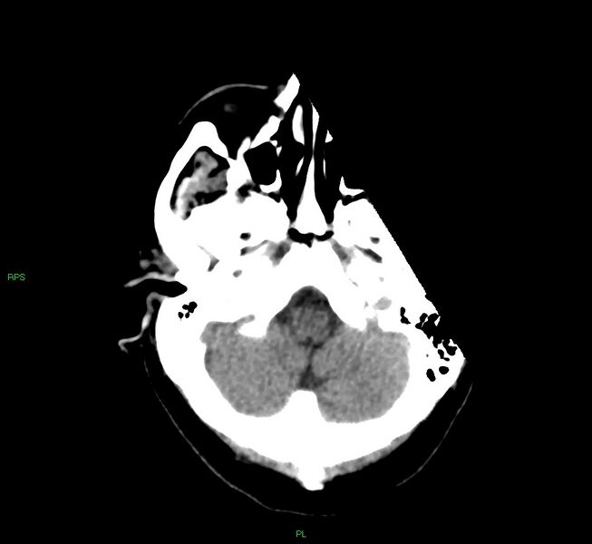 File:Cerebral amyloid angiopathy-associated lobar intracerebral hemorrhage (Radiopaedia 58569-65734 Axial non-contrast 49).jpg