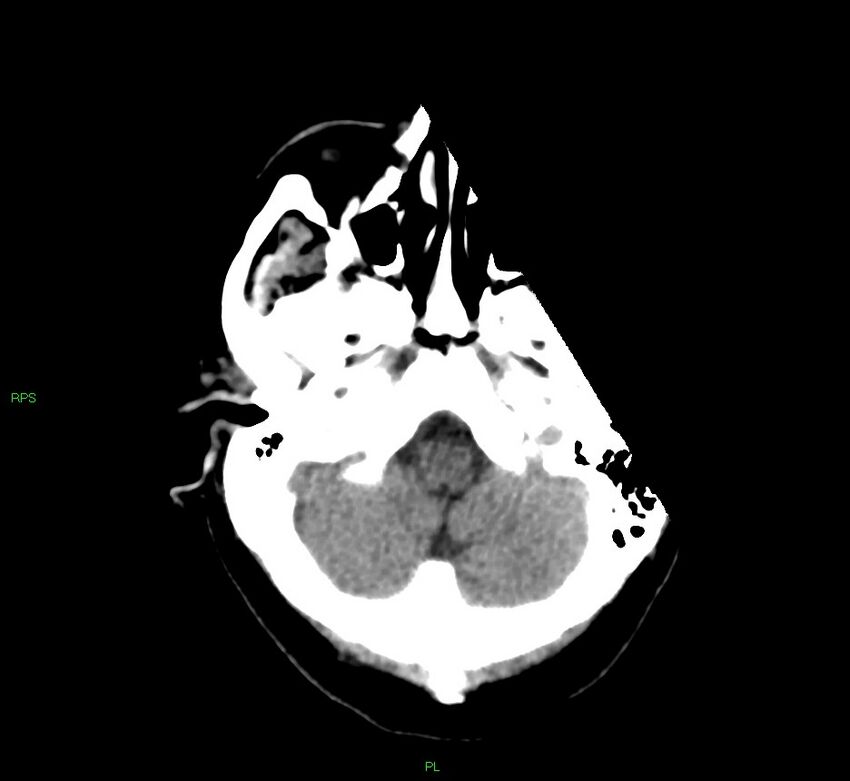 Cerebral amyloid angiopathy-associated lobar intracerebral hemorrhage (Radiopaedia 58569-65734 Axial non-contrast 49).jpg