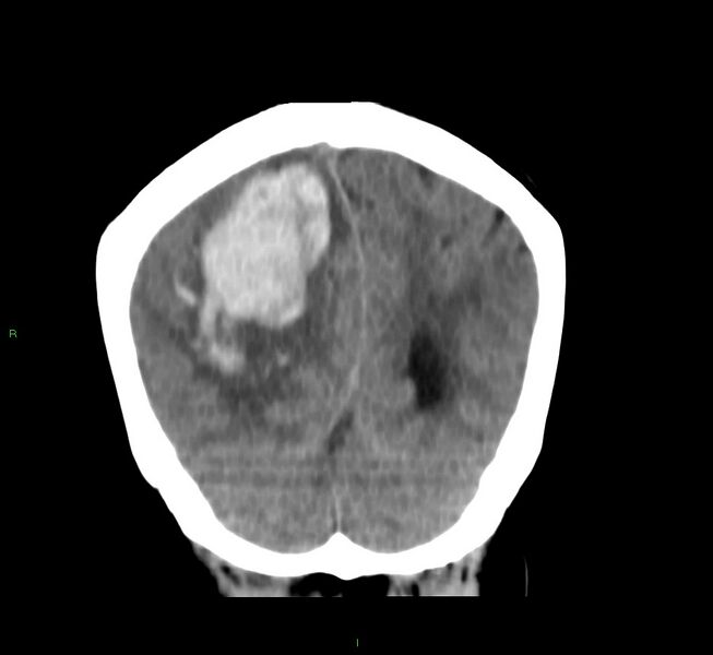 File:Cerebral amyloid angiopathy-associated lobar intracerebral hemorrhage (Radiopaedia 58751-65972 Coronal non-contrast 16).jpg