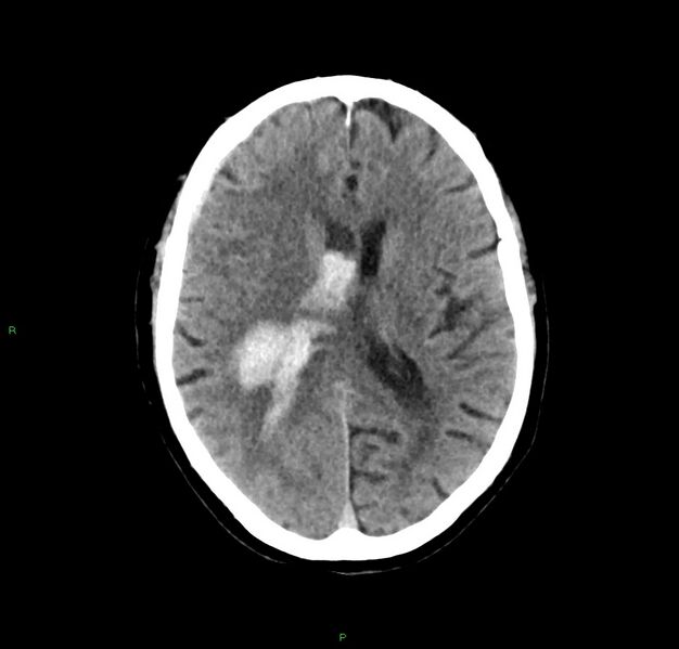 File:Cerebral amyloid angiopathy-associated lobar intracerebral hemorrhage (Radiopaedia 59356-66716 Axial non-contrast 21).jpg