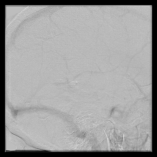 File:Cerebral aneurysm with rupture (Radiopaedia 29933-30458 LT ICA IC 52).jpg
