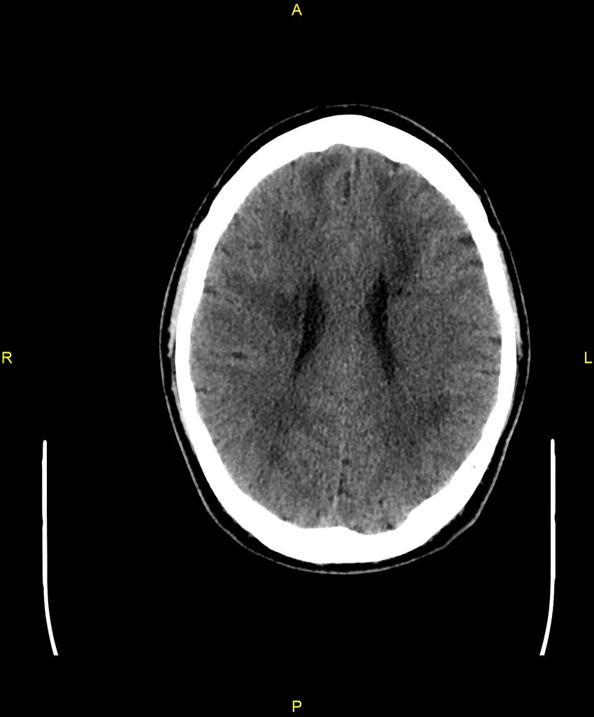 Cerebral autosomal dominant arteriopathy with subcortical infarcts and leukoencephalopathy (CADASIL) (Radiopaedia 86108-102051 Axial non-contrast 71).jpg