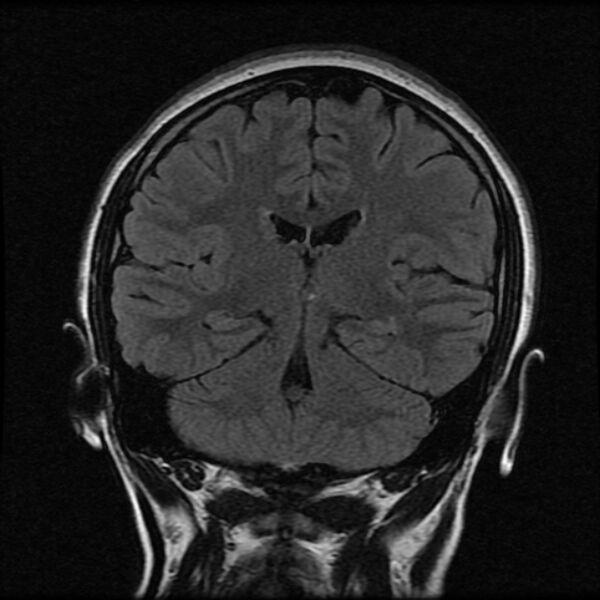 File:Cerebral cavernous malformation (Radiopaedia 44301-47942 Coronal FLAIR 14).jpg