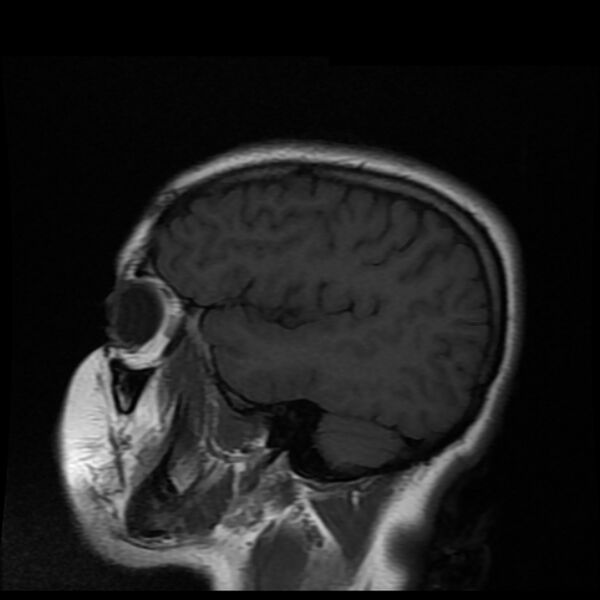 File:Cerebral cavernous malformation (Radiopaedia 44301-47942 Sagittal T1 17).jpg
