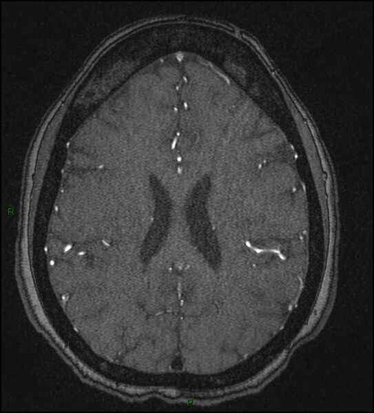File:Cerebral fat embolism (Radiopaedia 35022-36525 Axial TOF 134).jpg