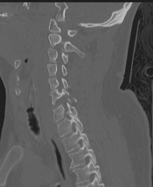 File:Cerebral hemorrhagic contusions and cervical spine fractures (Radiopaedia 32865-33841 Sagittal bone window 44).jpg