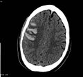 Cerebral vein thrombosis (Radiopaedia 4408-23048 Axial non-contrast 1).jpg