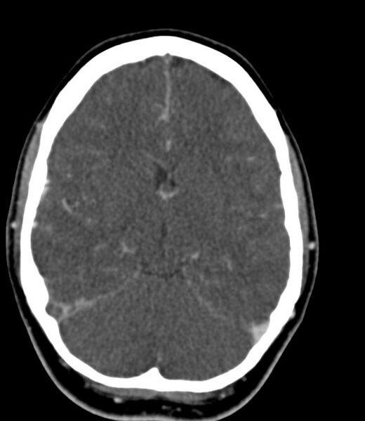 File:Cerebral venous sinus thrombosis (Radiopaedia 59224-66646 Axial C+ delayed 30).jpg