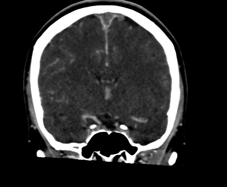 File:Cerebral venous sinus thrombosis (Radiopaedia 59224-66646 Coronal C+ delayed 31).jpg