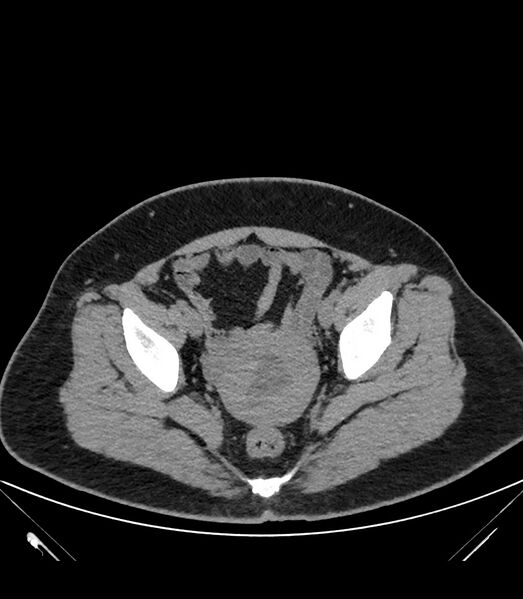 File:Cervical aortic arch with coarctation and aneurysms (Radiopaedia 44035-47552 Axial non-contrast 89).jpg