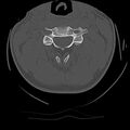 Cervical flexion teardrop fracture with cord hemorrhage (Radiopaedia 32497-33454 Axial bone window 32).jpg