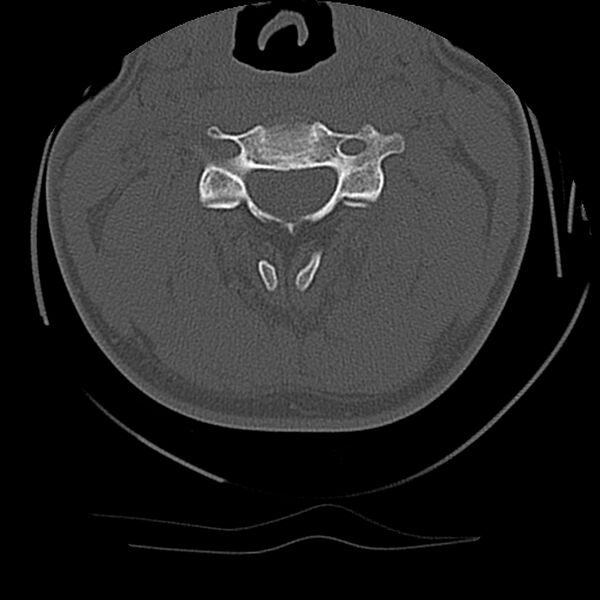 File:Cervical flexion teardrop fracture with cord hemorrhage (Radiopaedia 32497-33454 Axial bone window 32).jpg