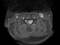 Cervical schwannoma (Radiopaedia 72399-82934 Axial T1 C+ fat sat 7).jpg