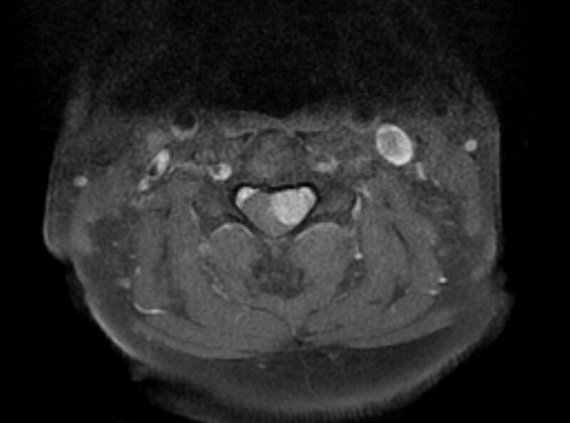 File:Cervical schwannoma (Radiopaedia 72399-82934 Axial T1 C+ fat sat 7).jpg