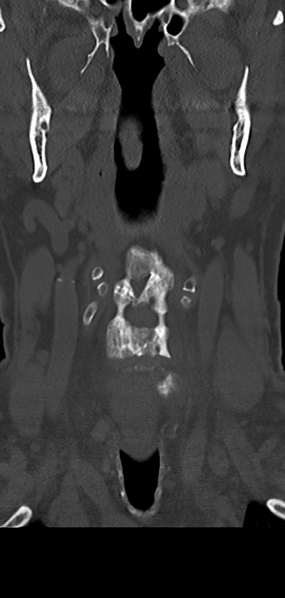 File:Cervical spine fracture - chalk stick (Radiopaedia 39116-41323 Coronal bone window 10).png