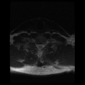 Cervical vertebrae metastasis (Radiopaedia 78814-91667 Axial T2 1).png