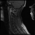Cervical vertebrae metastasis (Radiopaedia 78814-91667 G 10).png