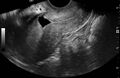 Cesarean section scar diverticulum (Radiopaedia 83150).jpg