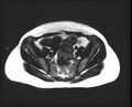 Cesarean section scar endometrioma (Radiopaedia 56569-63297 Axial T1 14).jpg