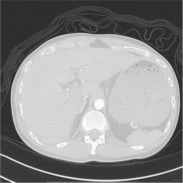 File:Chest and abdomen multi-trauma (Radiopaedia 26294-26425 lung window 100).jpg