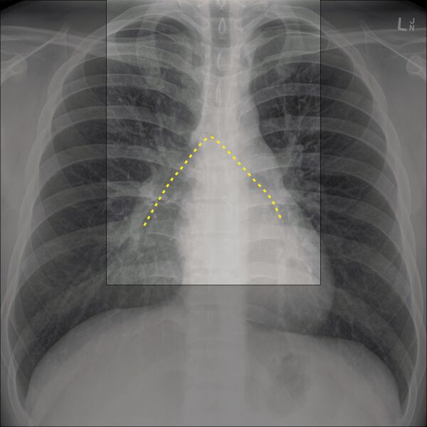 File:Chest x-ray - airway (Radiopaedia 32554-33506 C 1).jpg