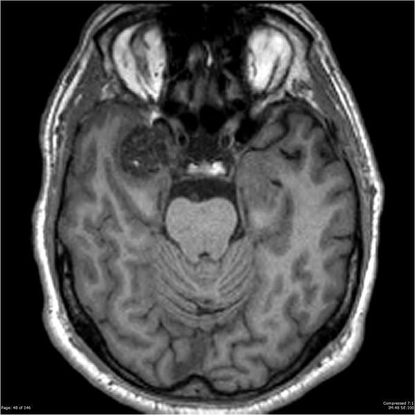 File:Chondrosarcoma of skull base- grade II (Radiopaedia 40948-43654 Axial T1 48).jpg