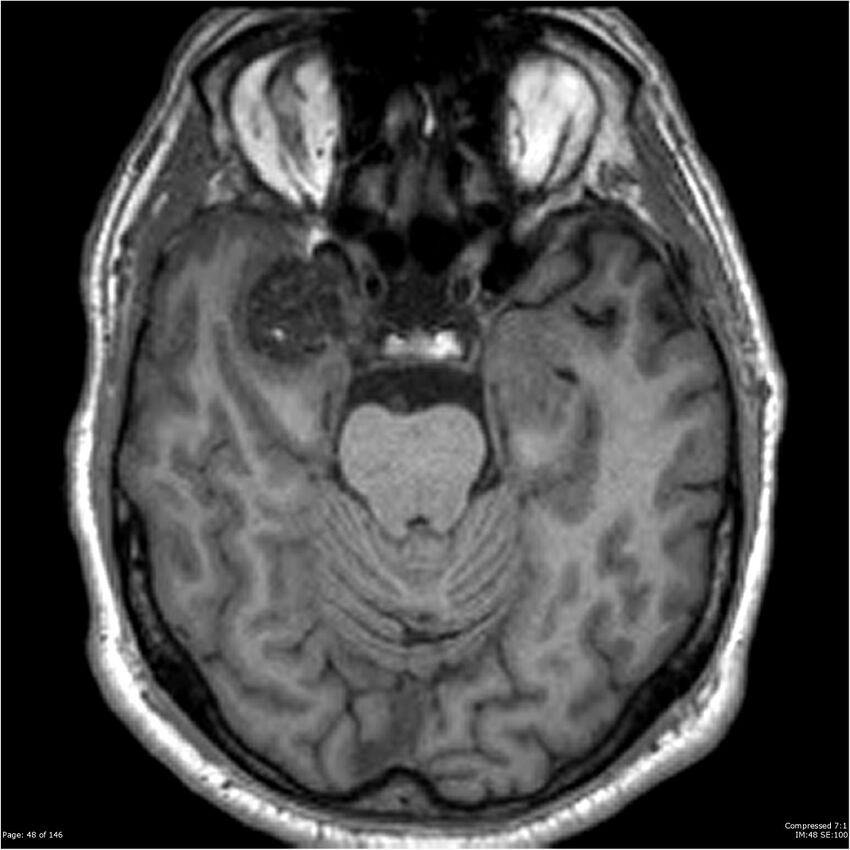 Chondrosarcoma of skull base- grade II (Radiopaedia 40948-43654 Axial T1 48).jpg