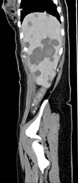 File:Choriocarcinoma liver metastases (Radiopaedia 74768-85766 C 145).jpg