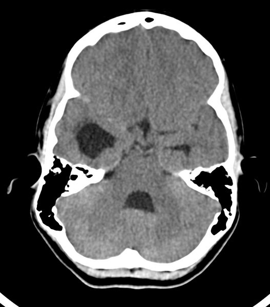File:Choroid plexus carcinoma (Radiopaedia 91013-108552 Axial non-contrast 20).jpg