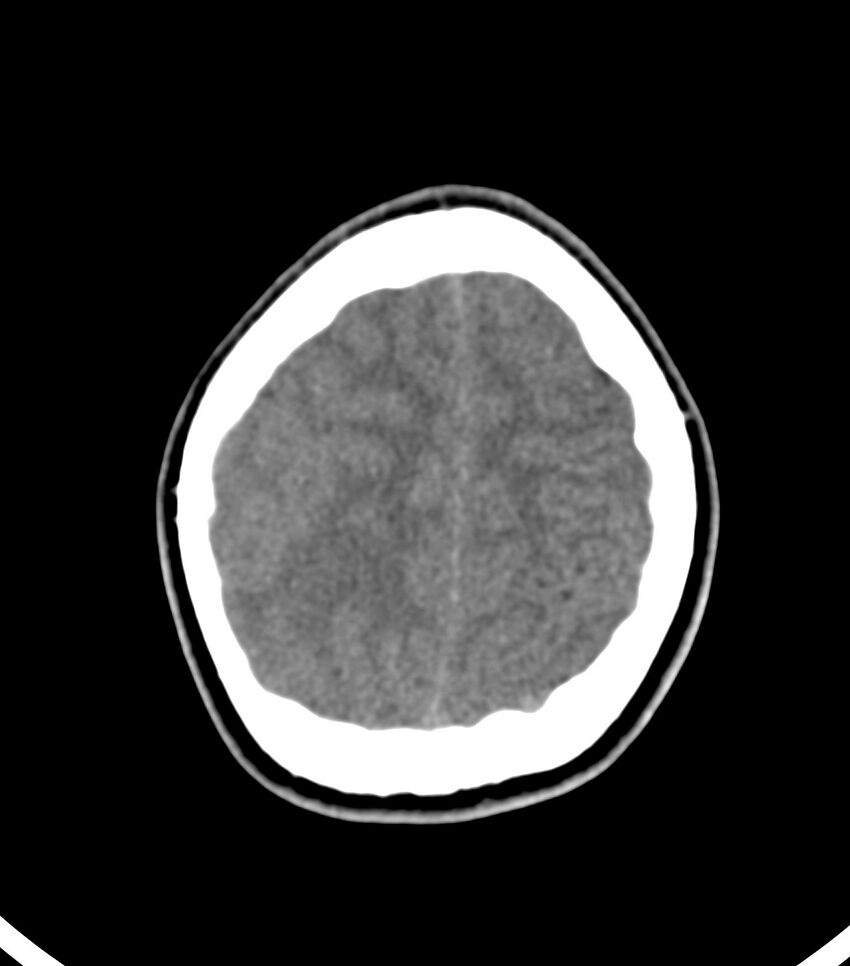 Choroid plexus carcinoma (Radiopaedia 91013-108552 Axial non-contrast 51).jpg