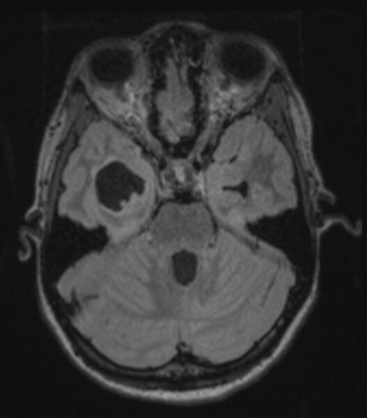 File:Choroid plexus carcinoma (Radiopaedia 91013-108553 Axial FLAIR C+ 105).jpg