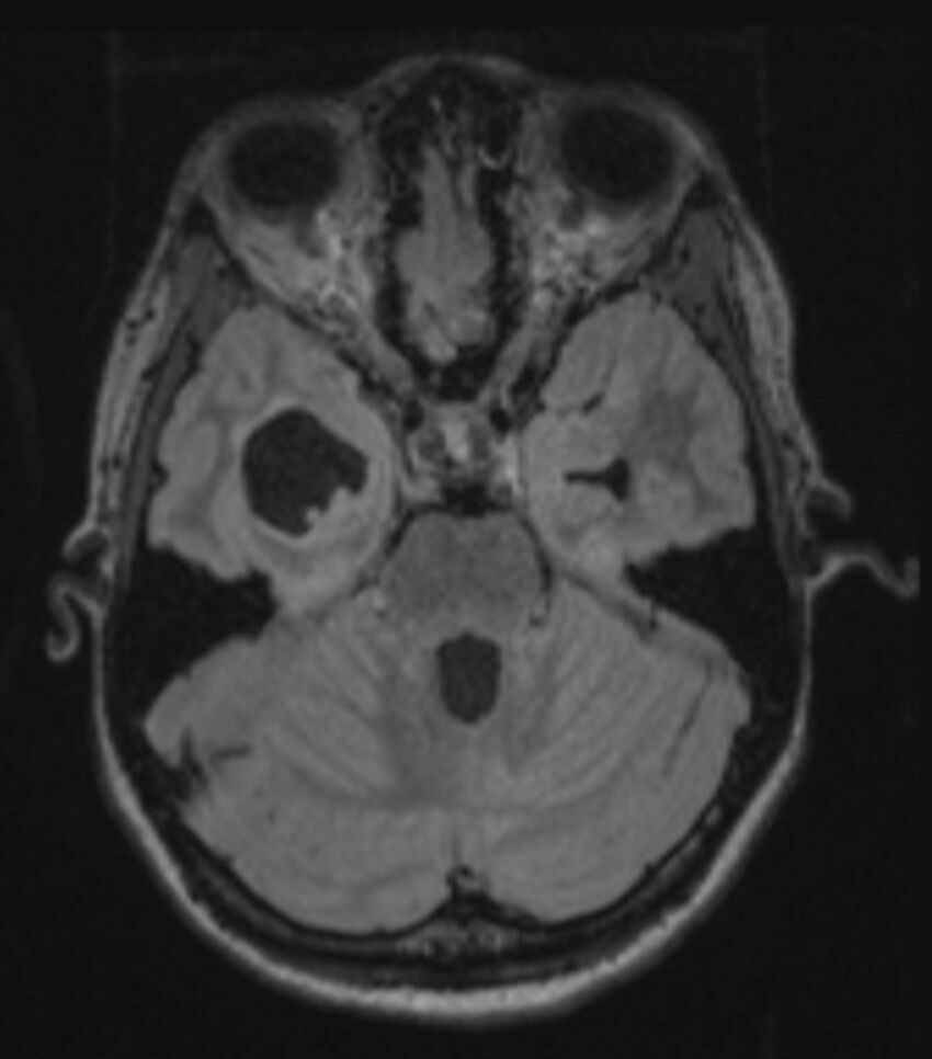 Choroid plexus carcinoma (Radiopaedia 91013-108553 Axial FLAIR C+ 105).jpg
