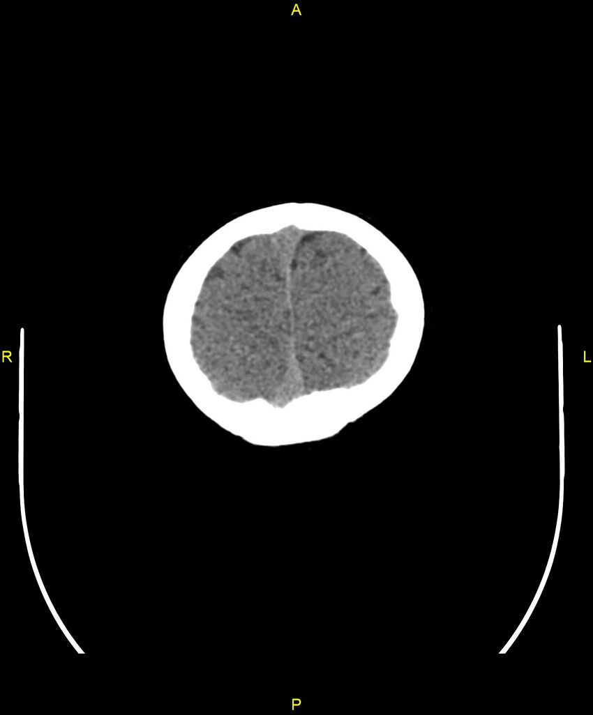 Choroidal fissure cyst (Radiopaedia 89481-106465 Axial non-contrast 110).jpg